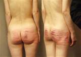 42 Jpg In Gallery Severe Caning Spanking Corporal Punishment Marks And